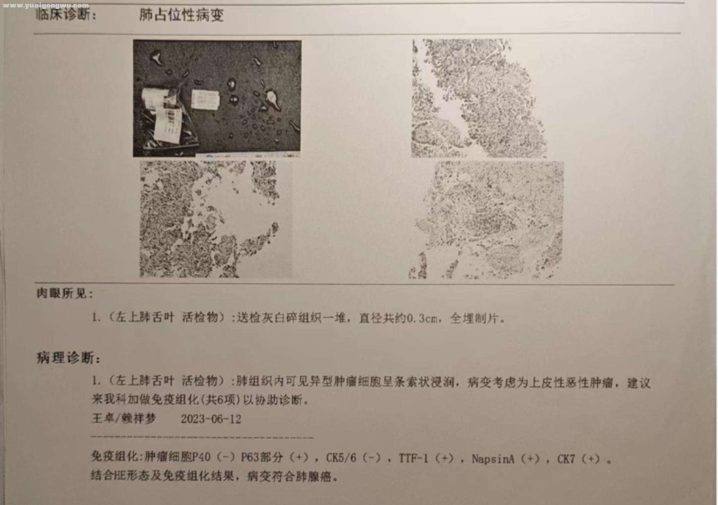 6月15日-病理活体组织诊断报告.jpg